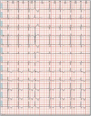 A diabetic patient increased premature ventricular contractions after using liraglutide: a case report
